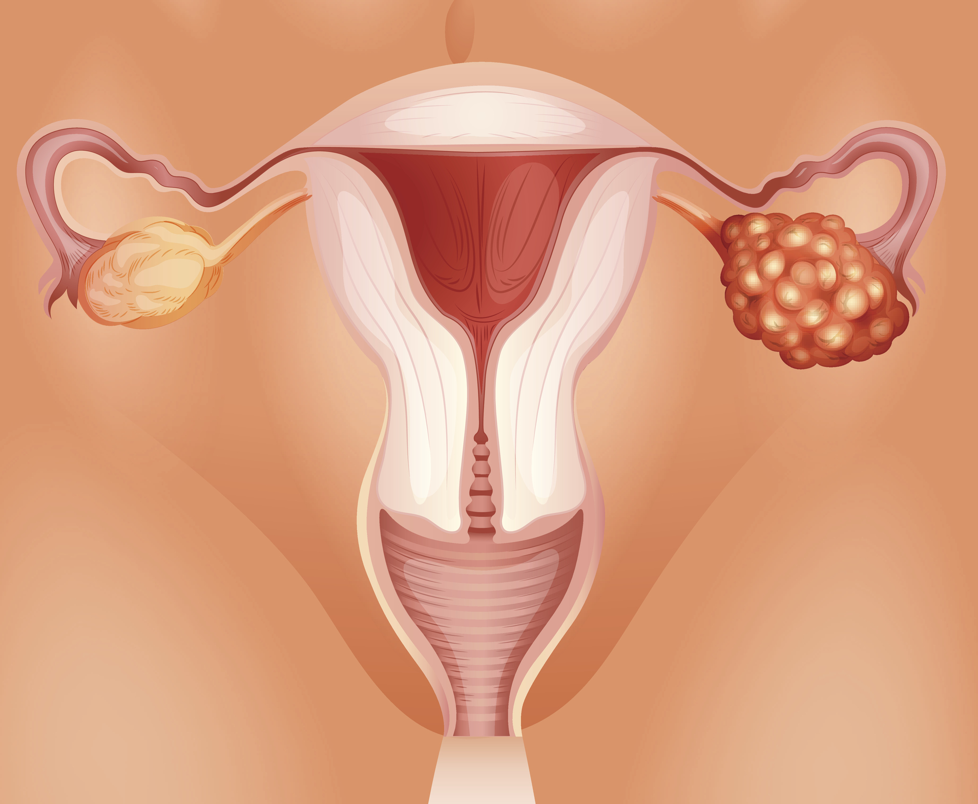 Ooforectomia bilateral na pré-menopausa foi mais fortemente